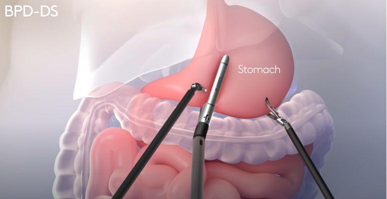 Da Vinci BPD-DS procedure video thumbnail