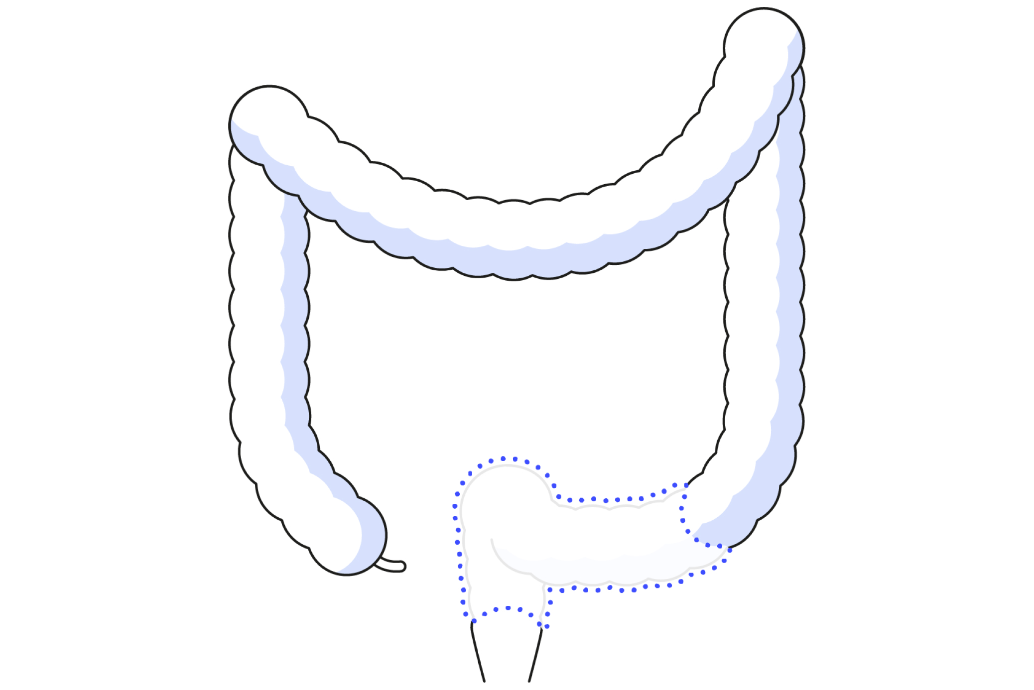 Diagram showing low anterior resection in colorectal surgery