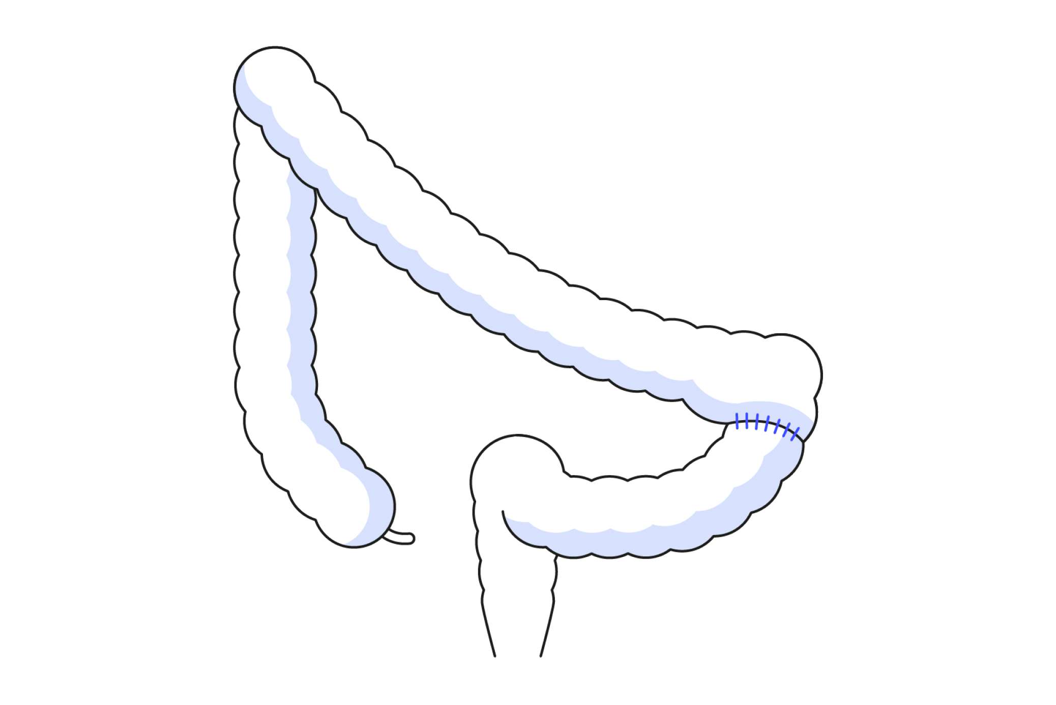 Diagram showing an anastomosis in colorectal surgery