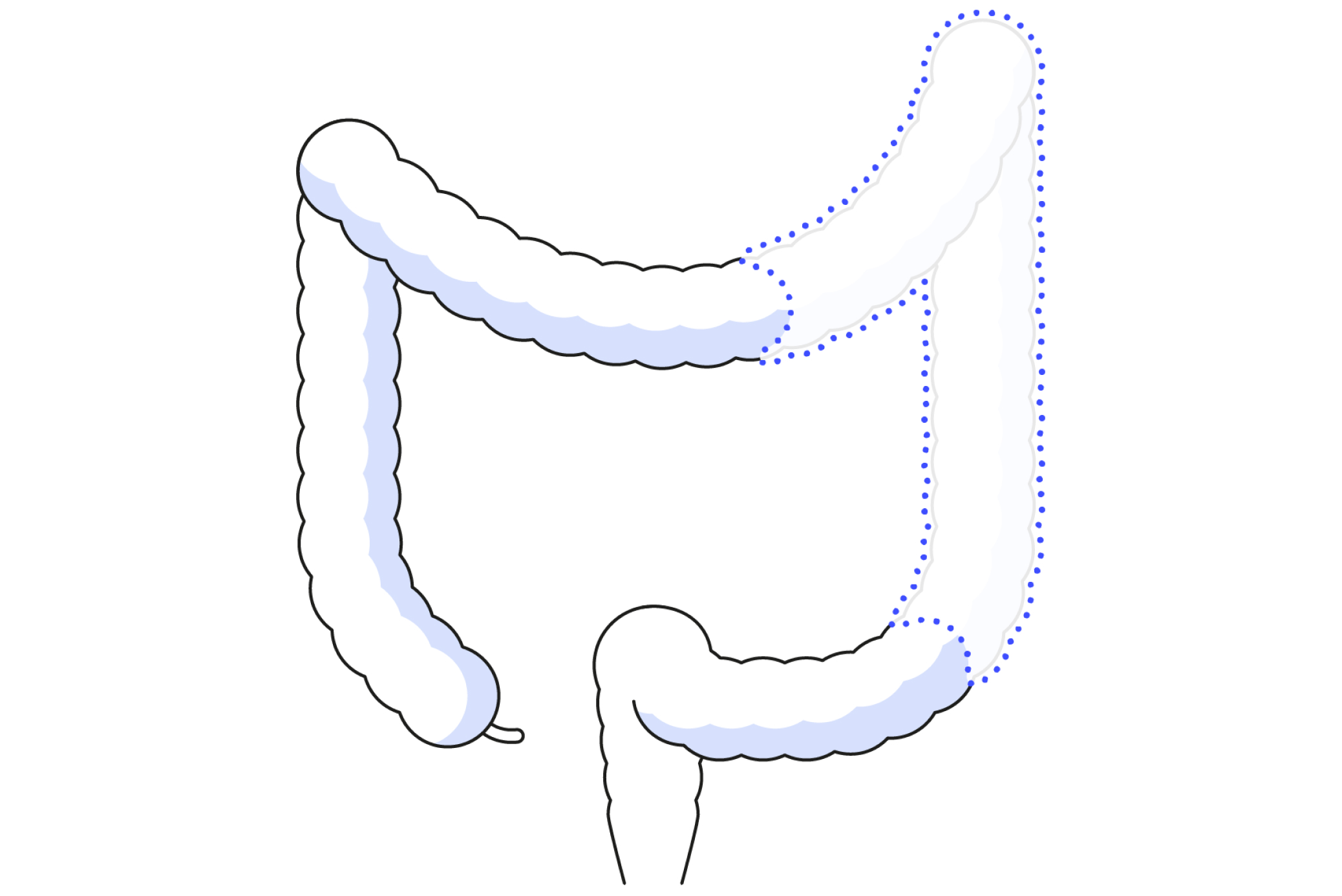 Diagram showing colectomy in colorectal surgery