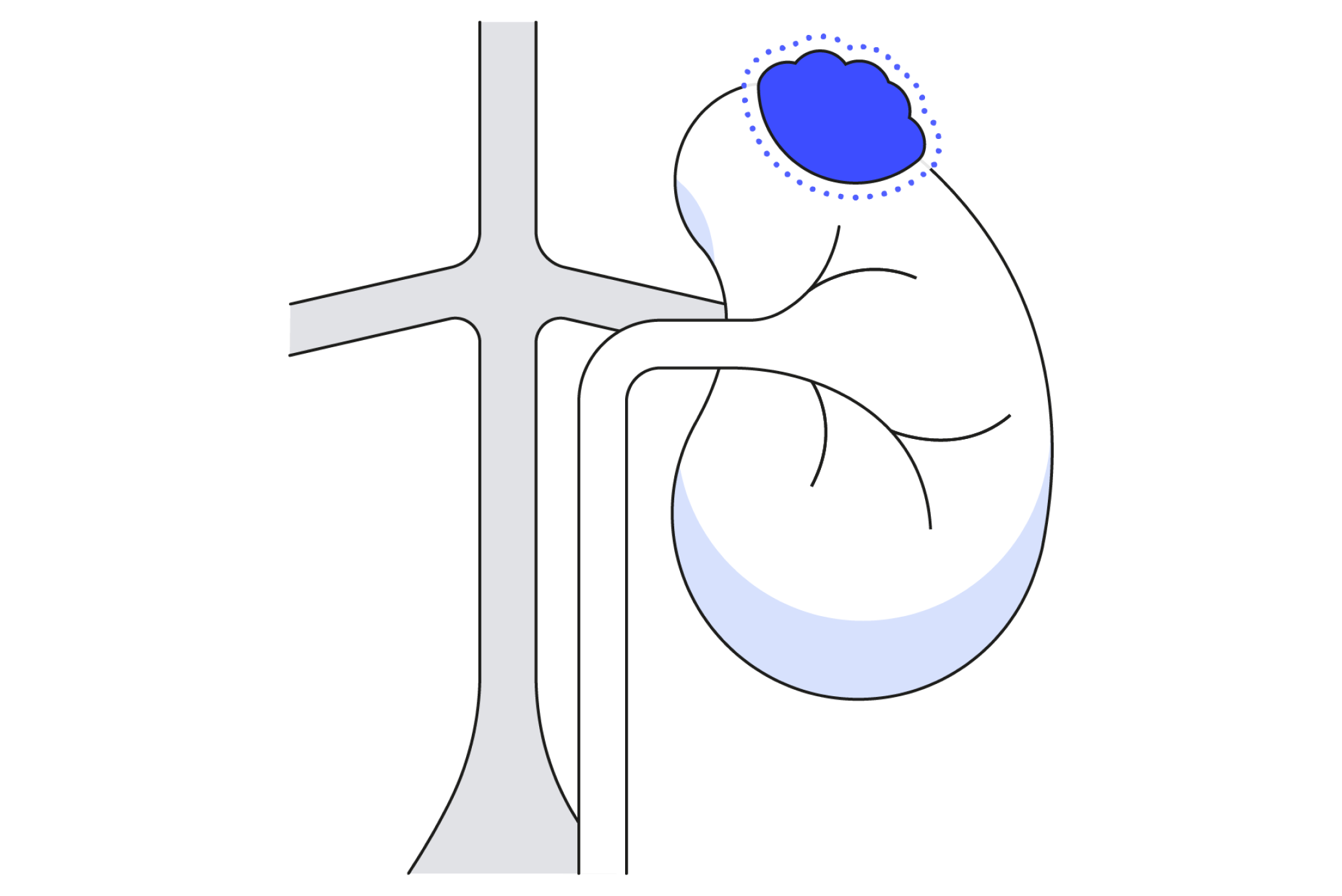 Diagram showing partial nephrectomy kidney surgery