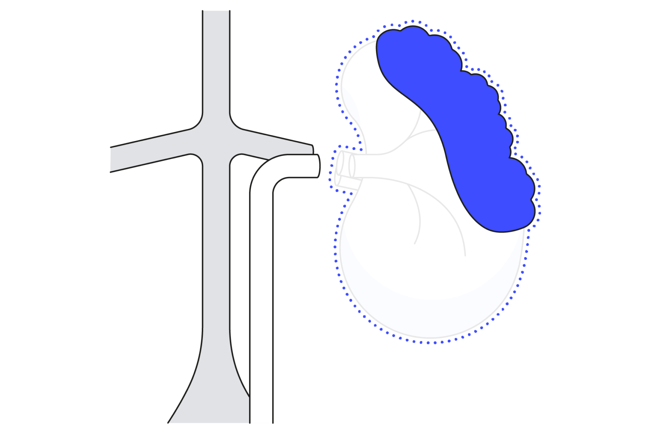 Diagram showing radical nephrectomy kidney surgery