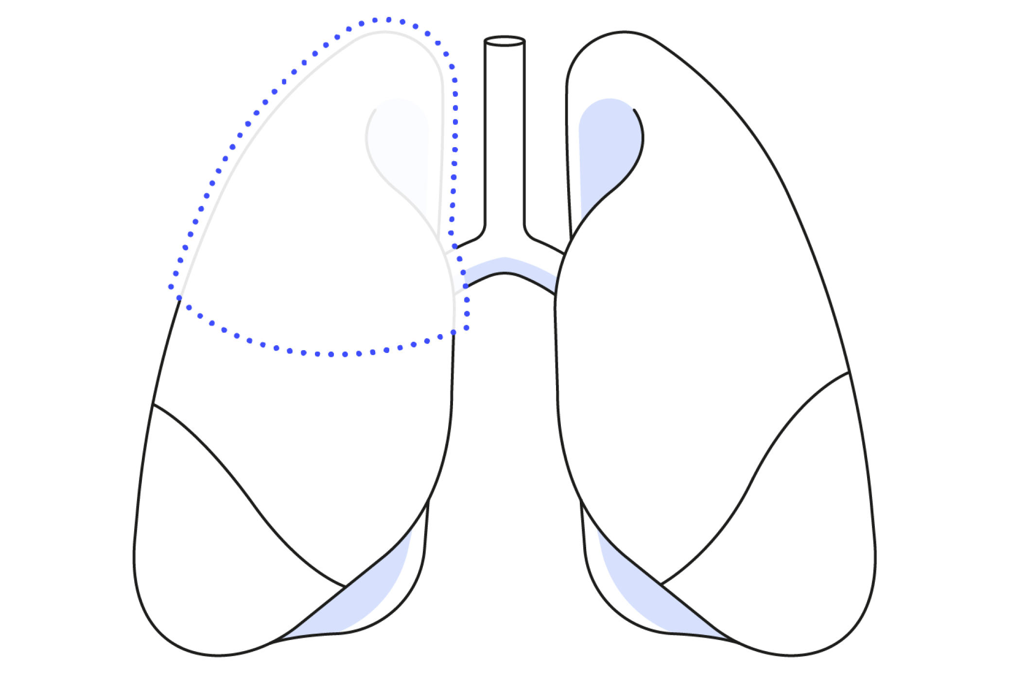 Diagram showing a lobectomy in lung surgery
