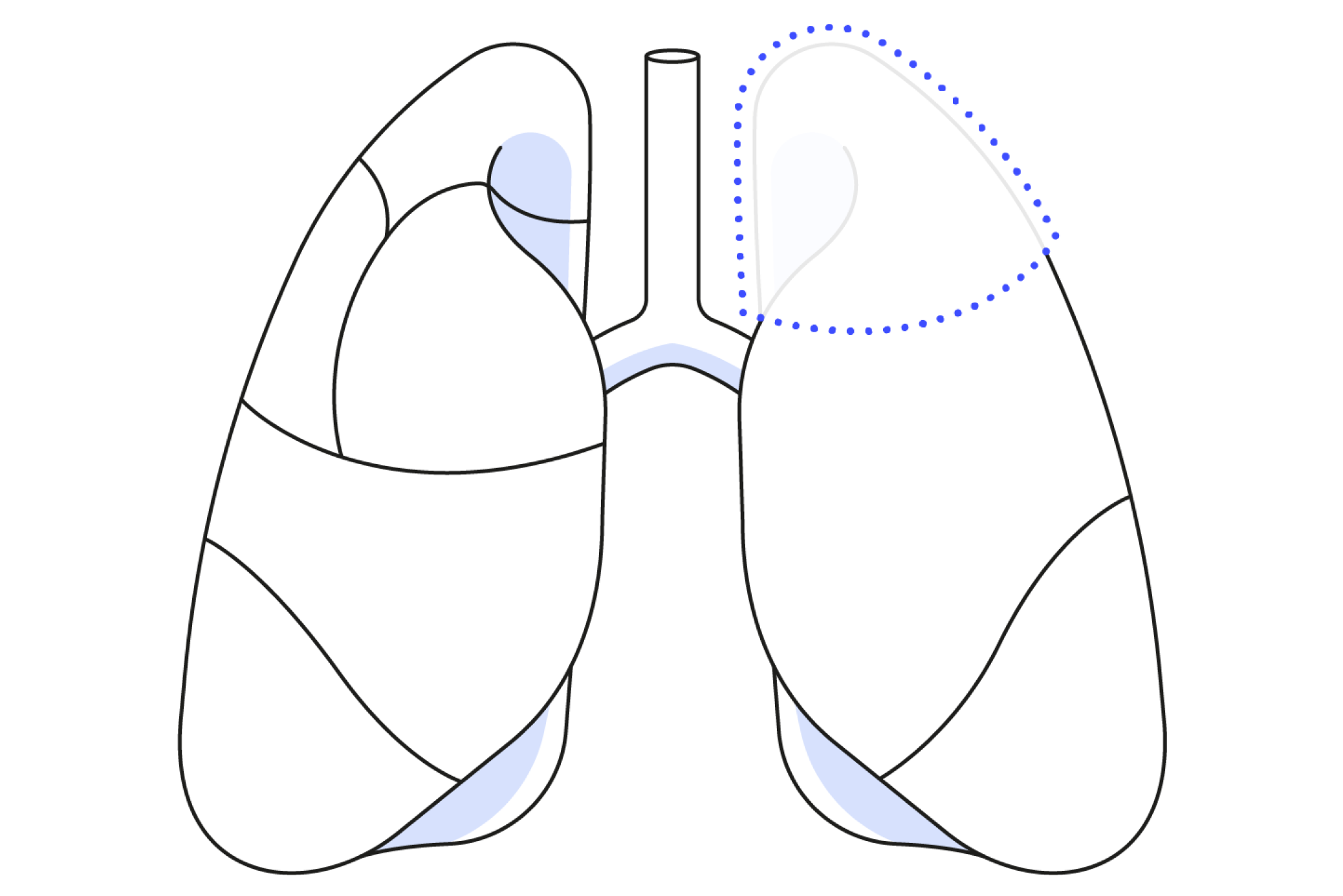 Diagram showing a segmentectomy in lung surgery