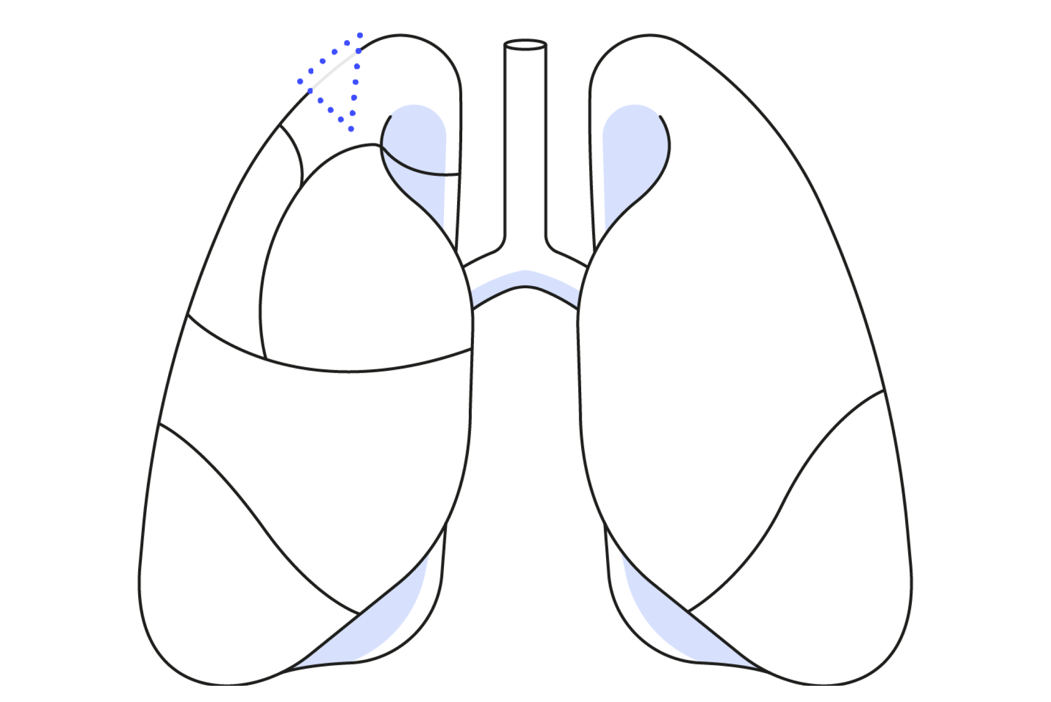 Diagram showing a wedge resection in lung surgery