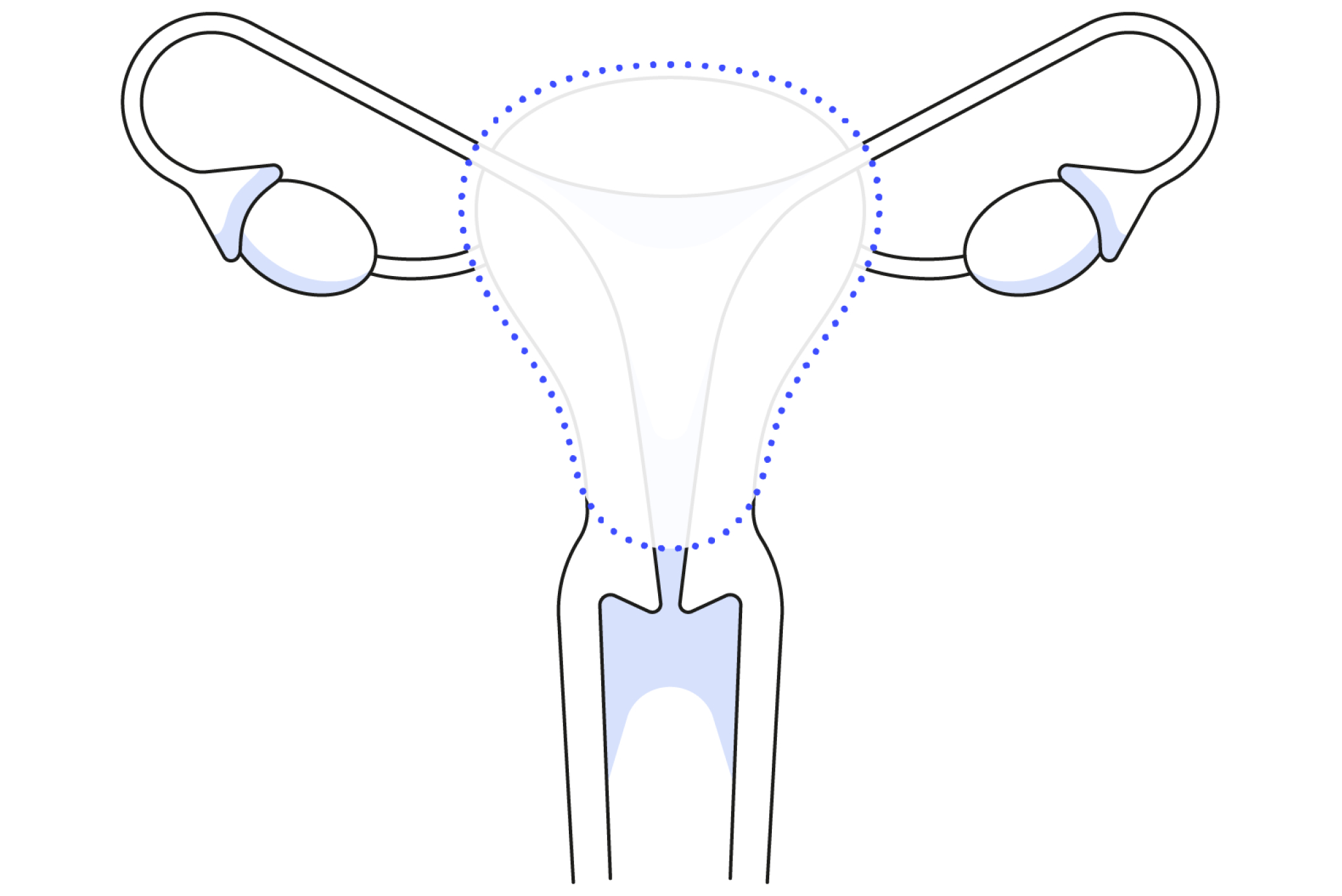 Diagram showing how partial hysterectomy surgery works