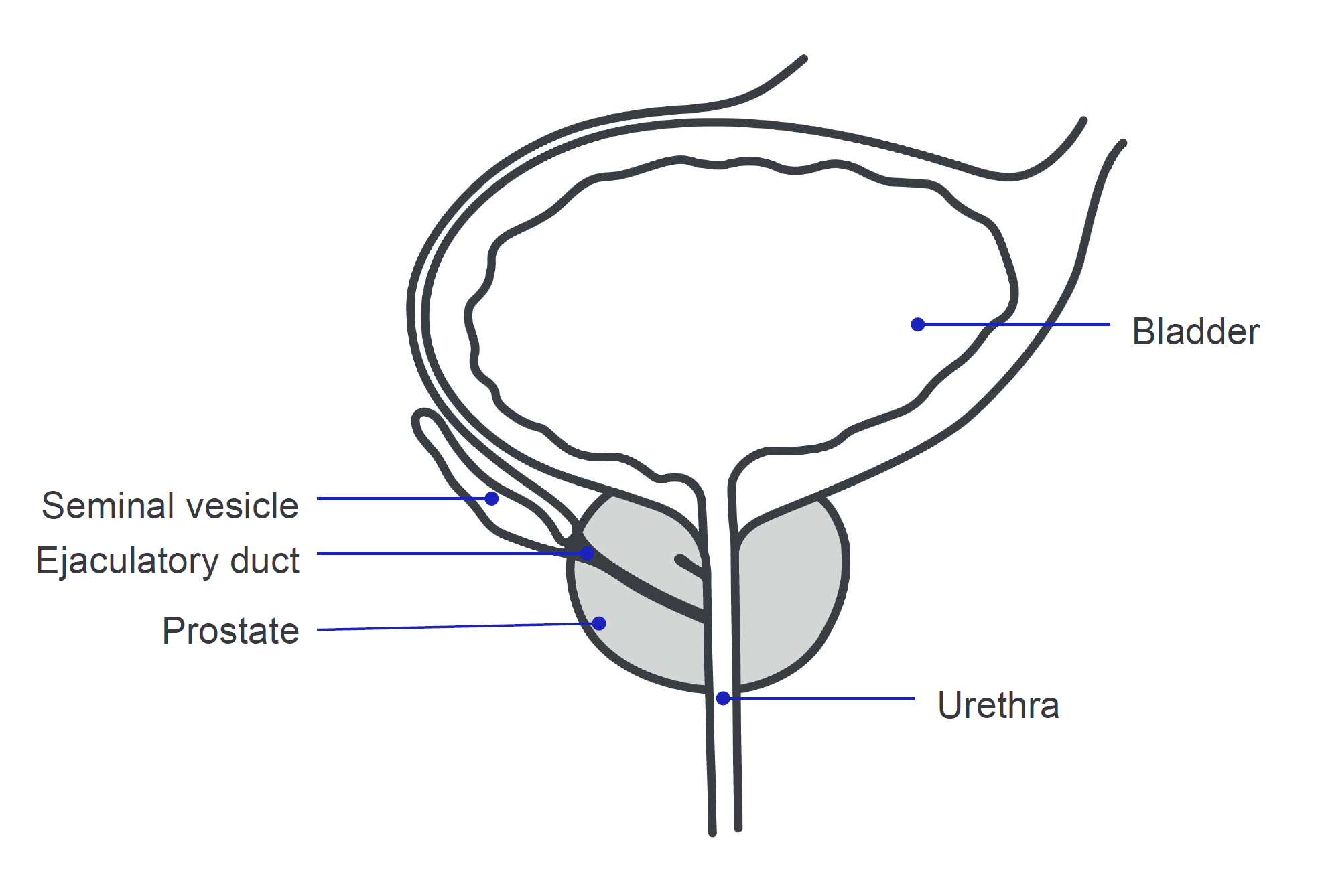 Diagram showing radical prostatectomy surgery