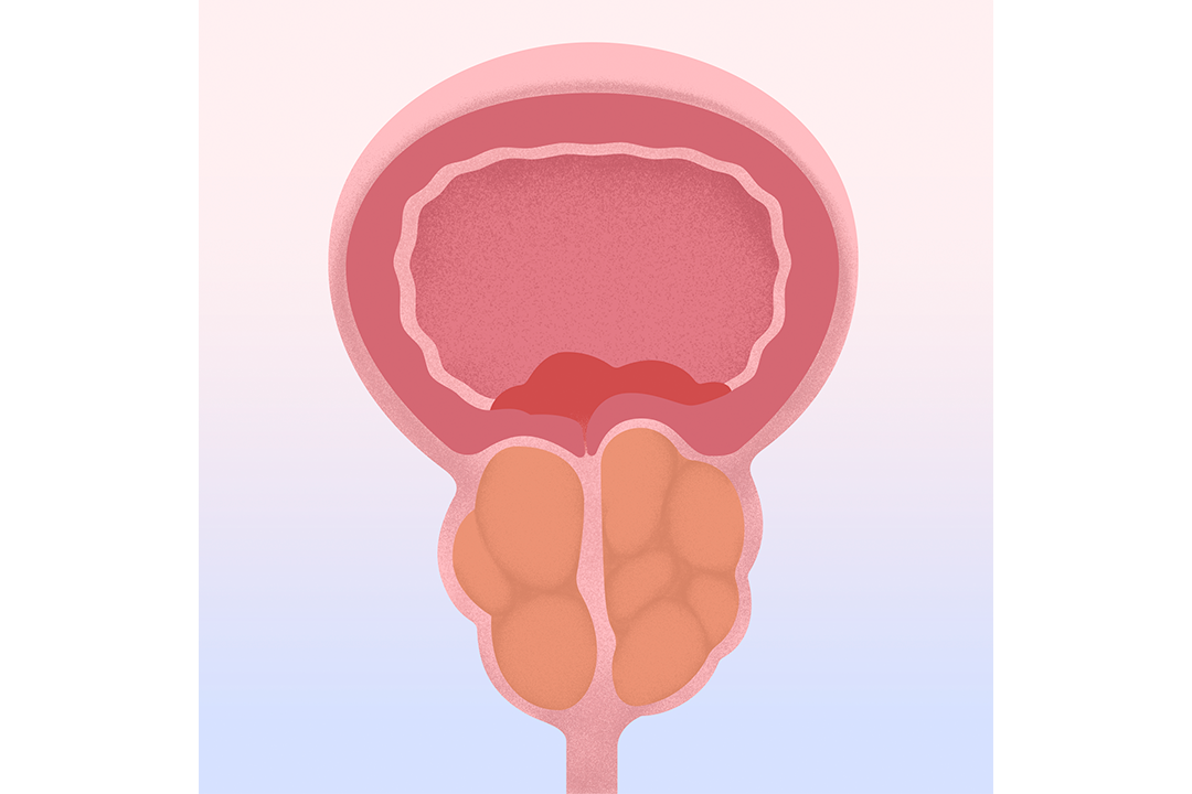 Diagram showing simple prostatectomy surgery removing enlarged inner prostate tissue