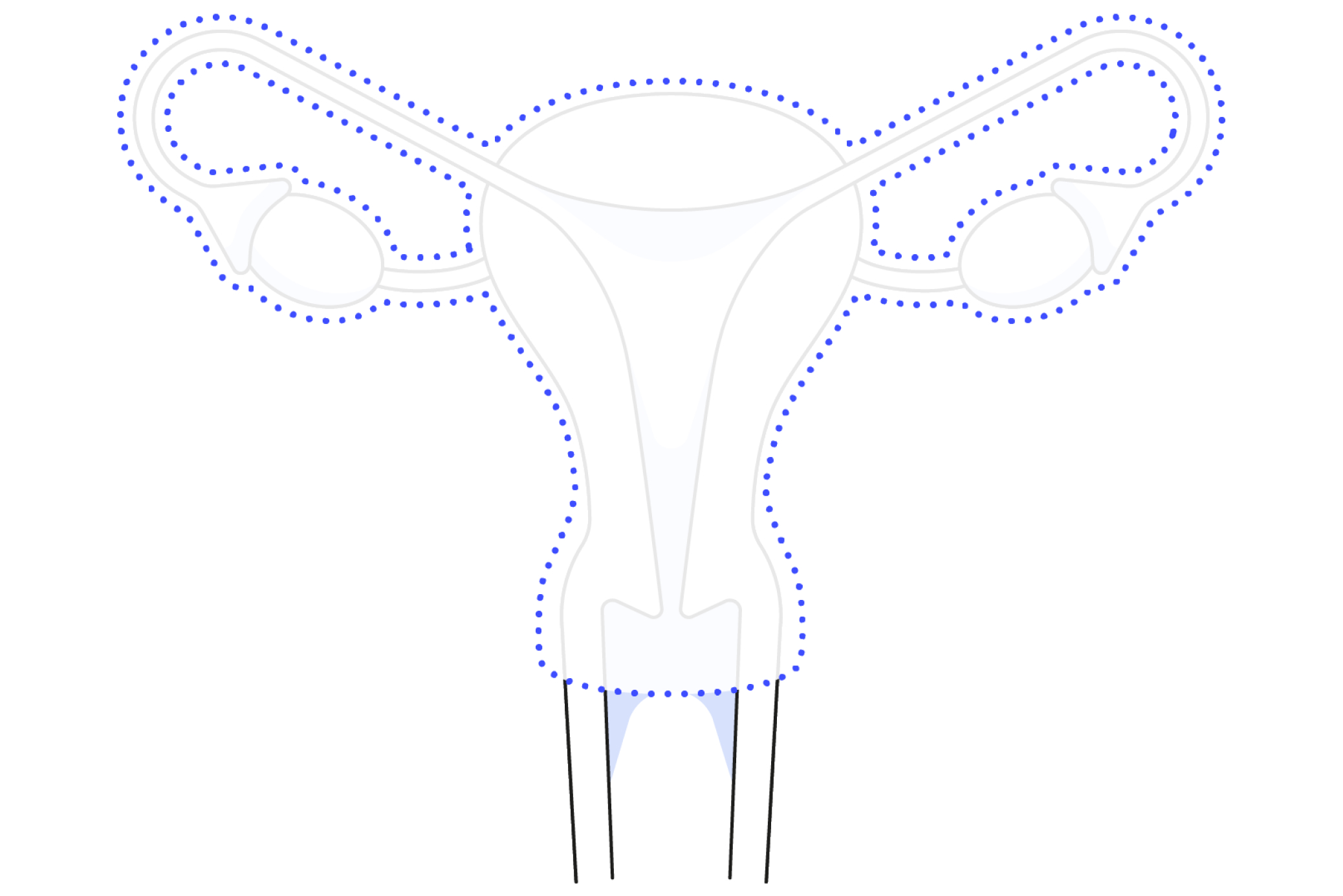 Diagram showing how radical hysterectomy surgery works