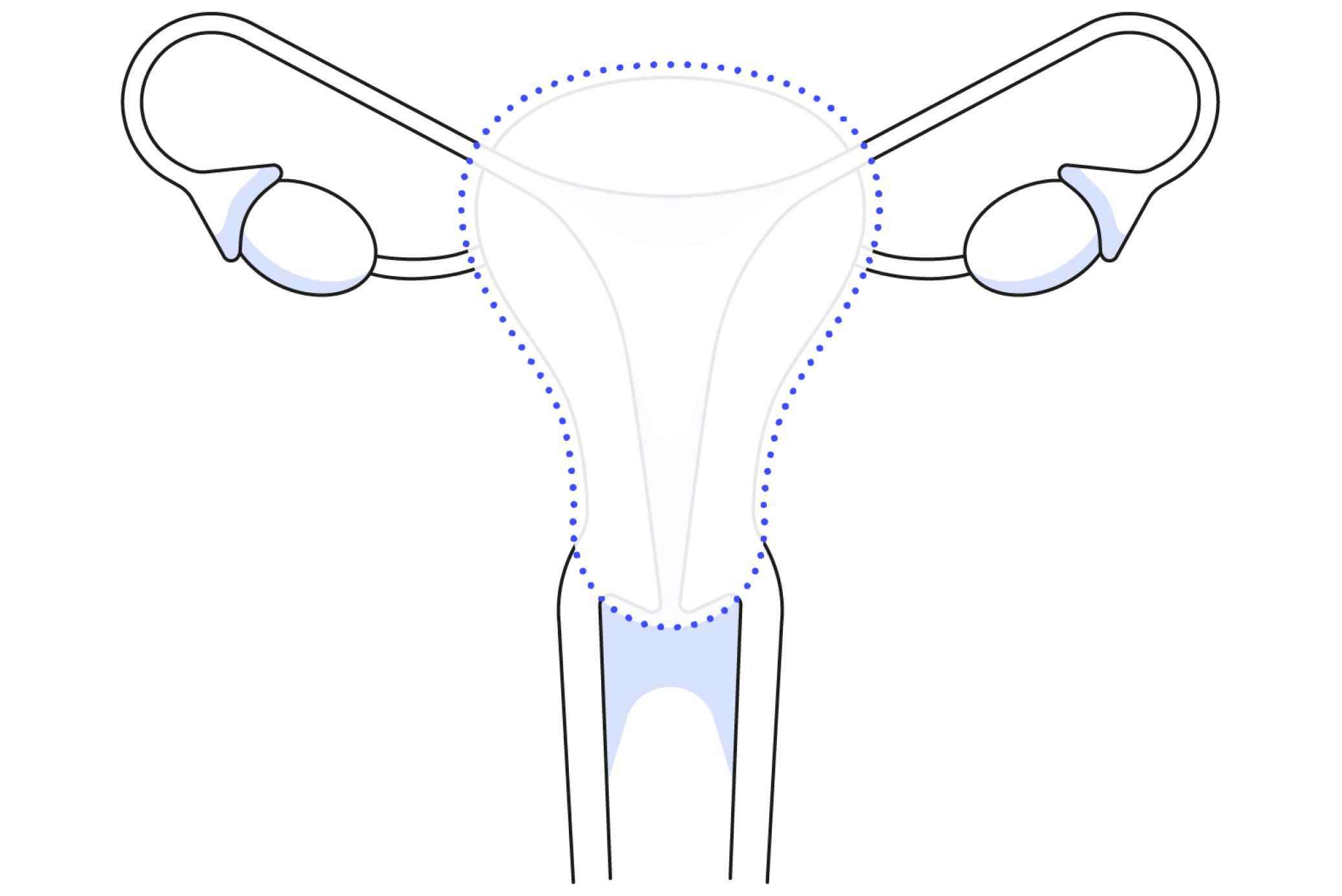 Diagram showing how simple or total hysterectomy surgery works