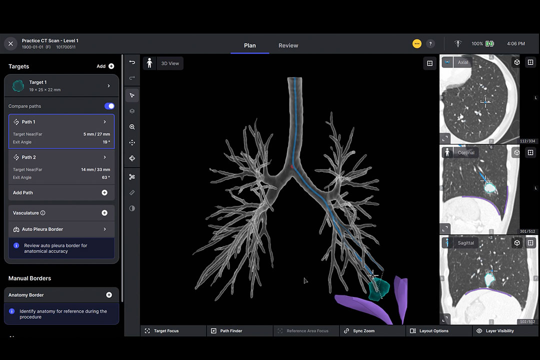 Ion PlanPoint software segmentation identifies small airways in the peripheral lung