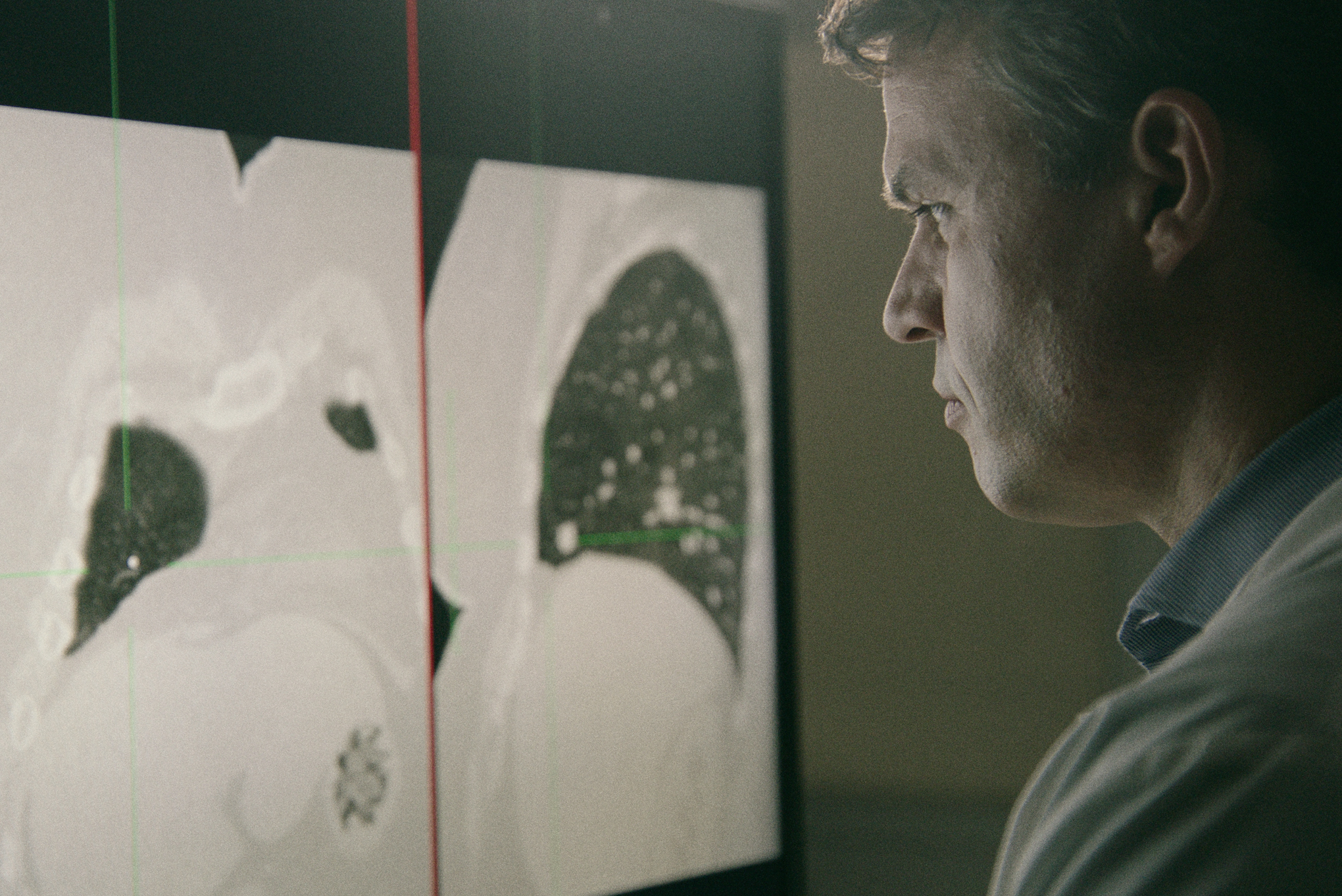 Surgeon looking at CT scans of the lung