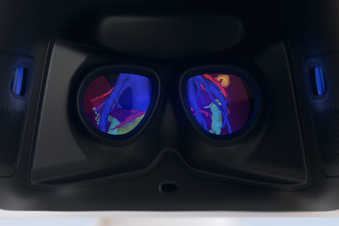 A digital 3D model shown in the da Vinci surgeon console viewer