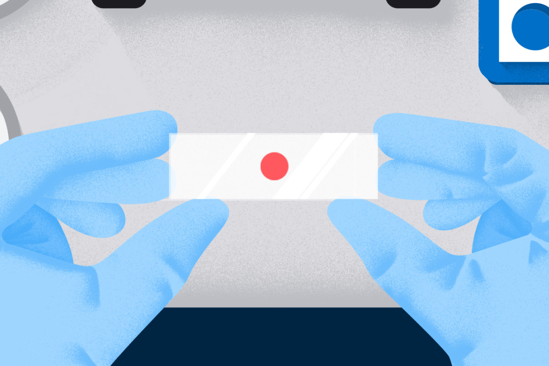 Illustration of lung biopsy