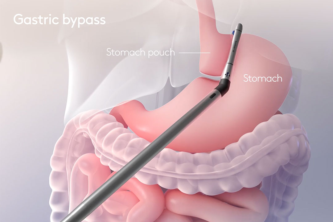 Screenshot of the gastric bypass procedure video showing a gastric bypass procedure
