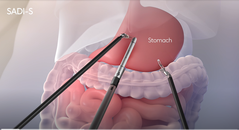 Thumbnail for SADI-S procedure video