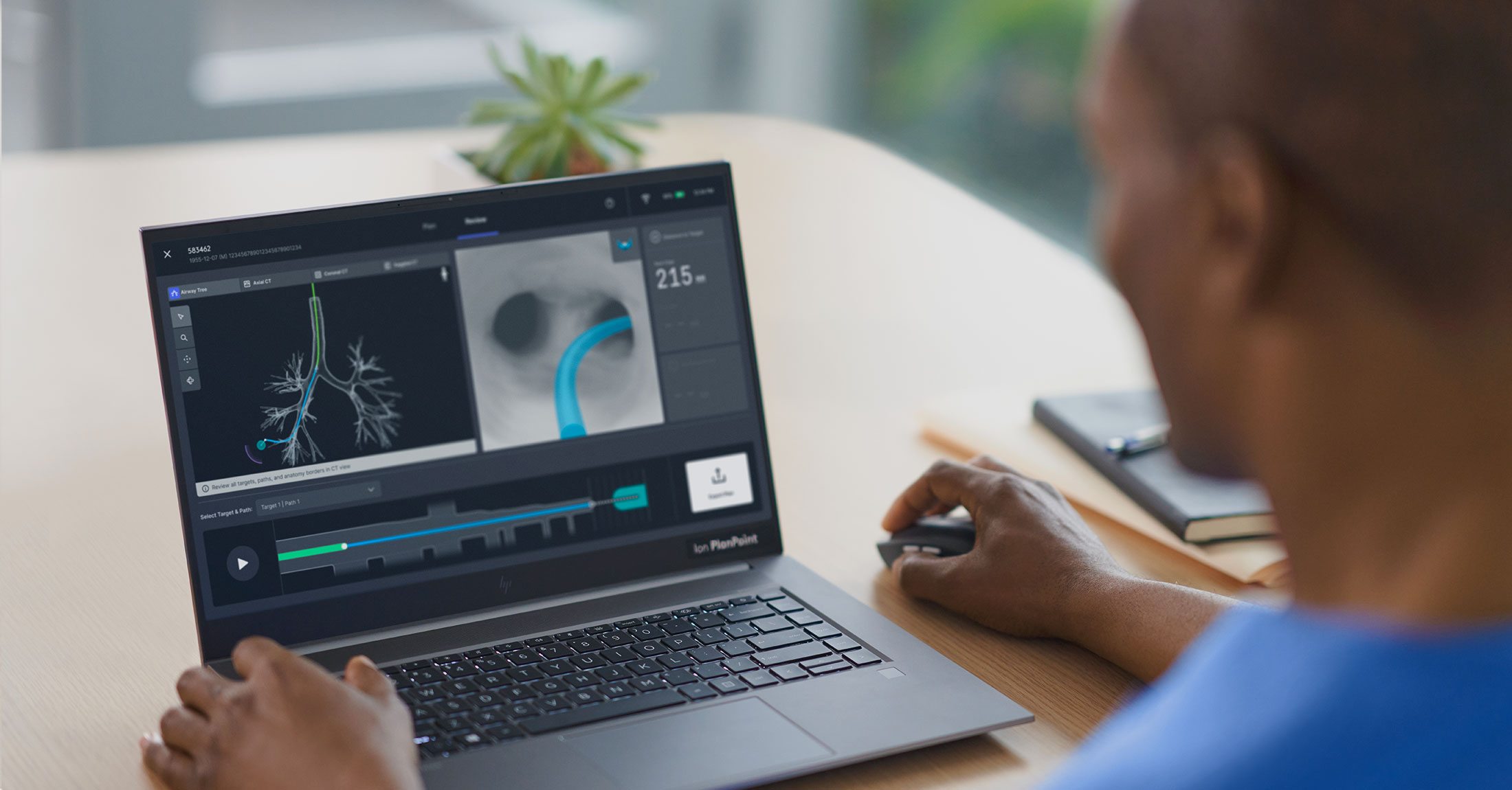 Ion PlanPoint segmentation software is used with the Ion endoluminal system for nodule biopsy