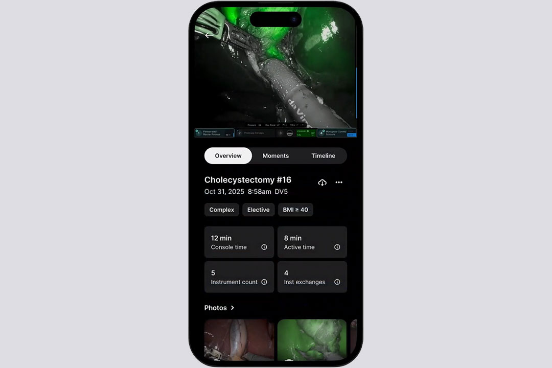 Cholecystectomy case on mobile phone  