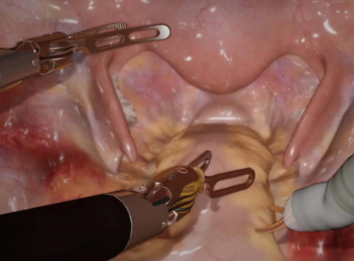 My Intuitive+ procedure module