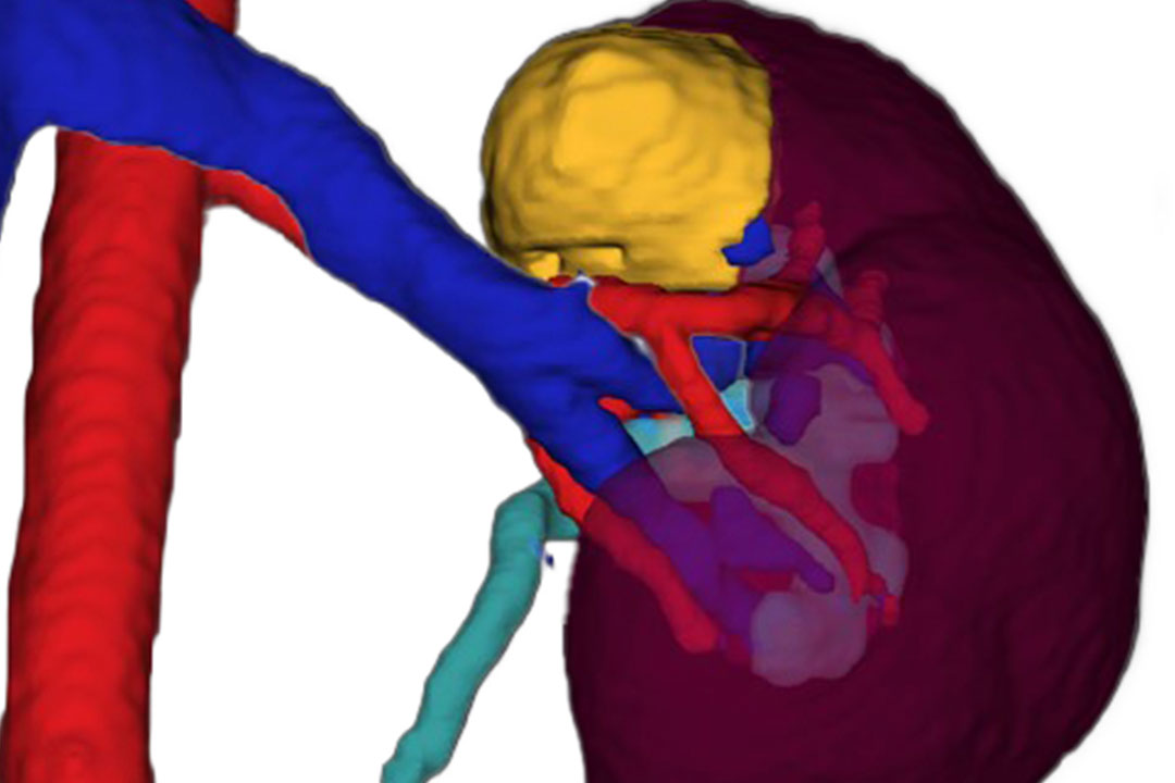 3d illustration of a left kidney with mass on upper pole