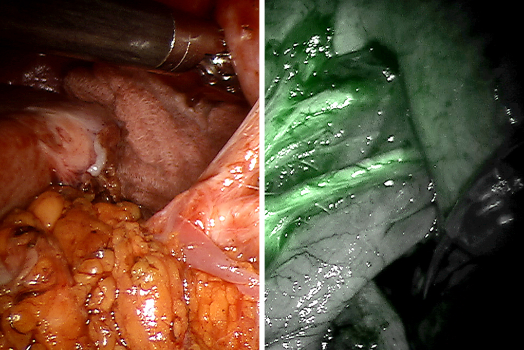 Firefly fluorescence imaging technology on-off comparison