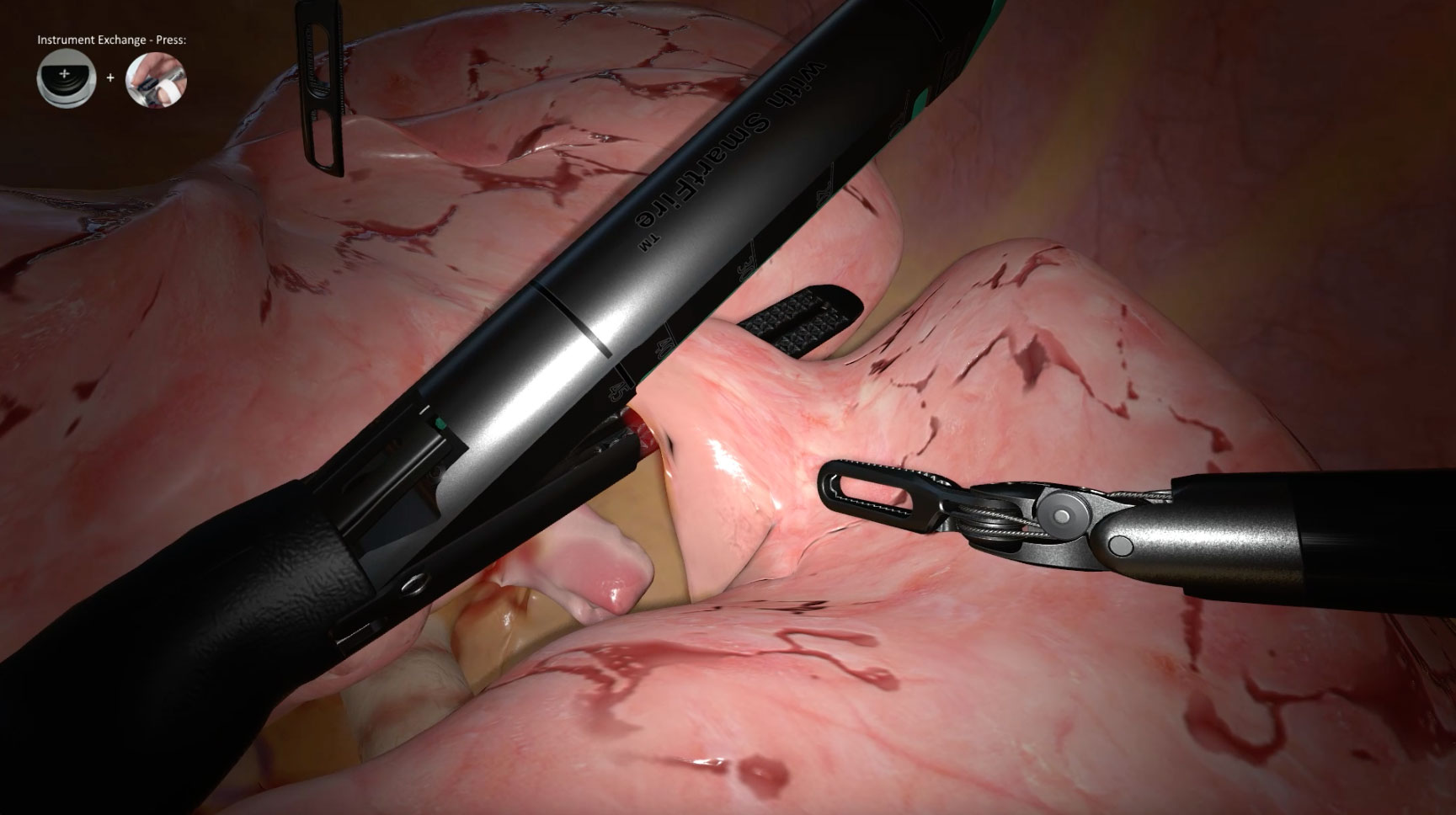 SimNow training module showing a lobectomy