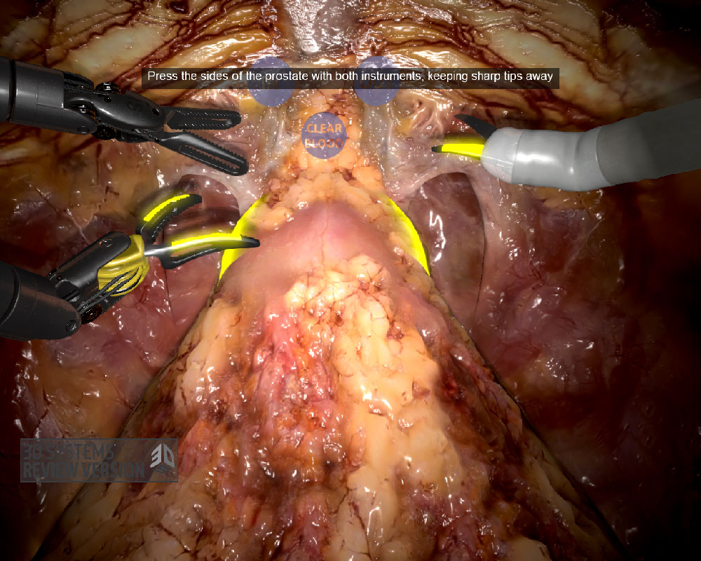 SimNow training module showing a prostatectomy