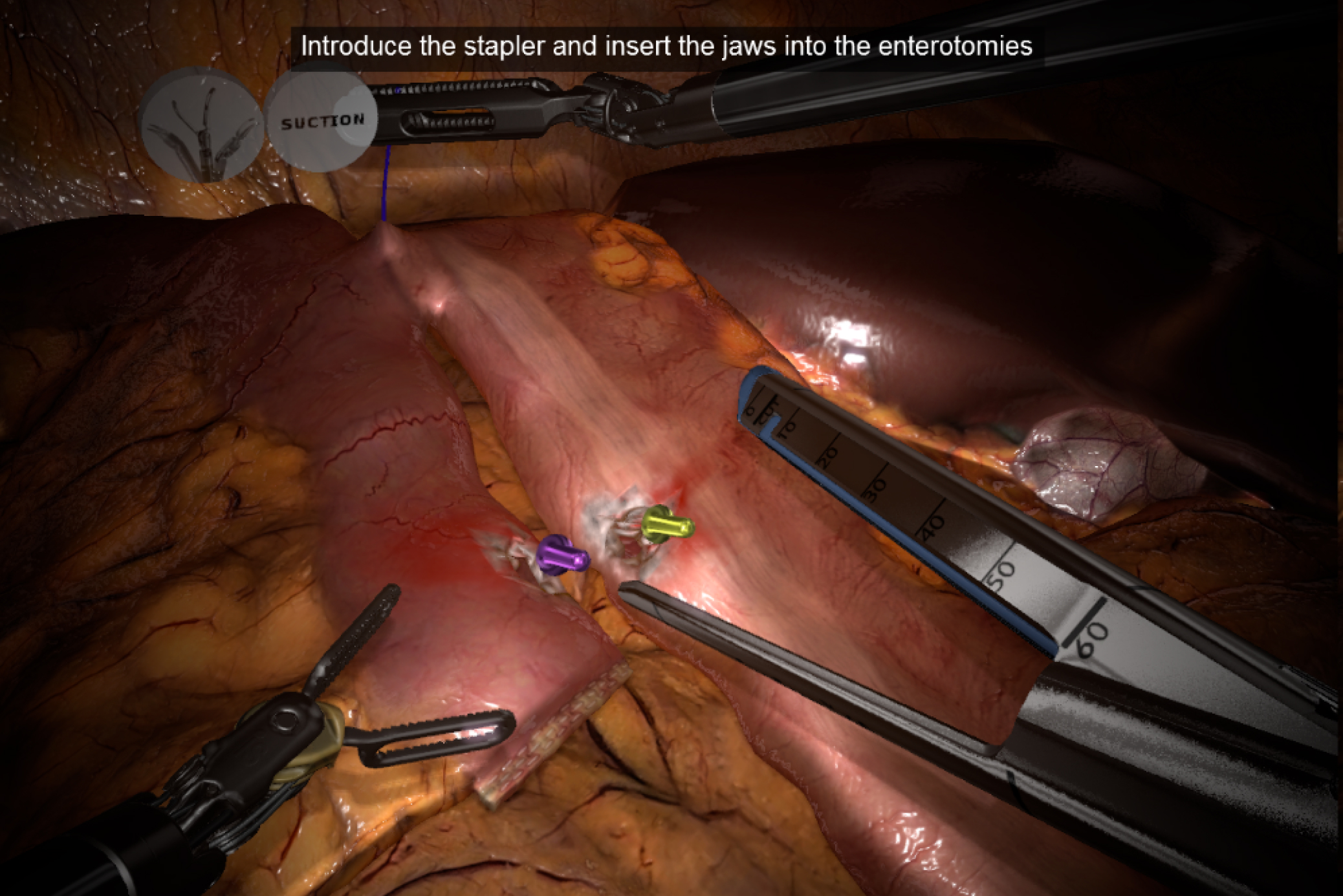 SimNow showing a guided intracorporeal ileocolic anastomosis
