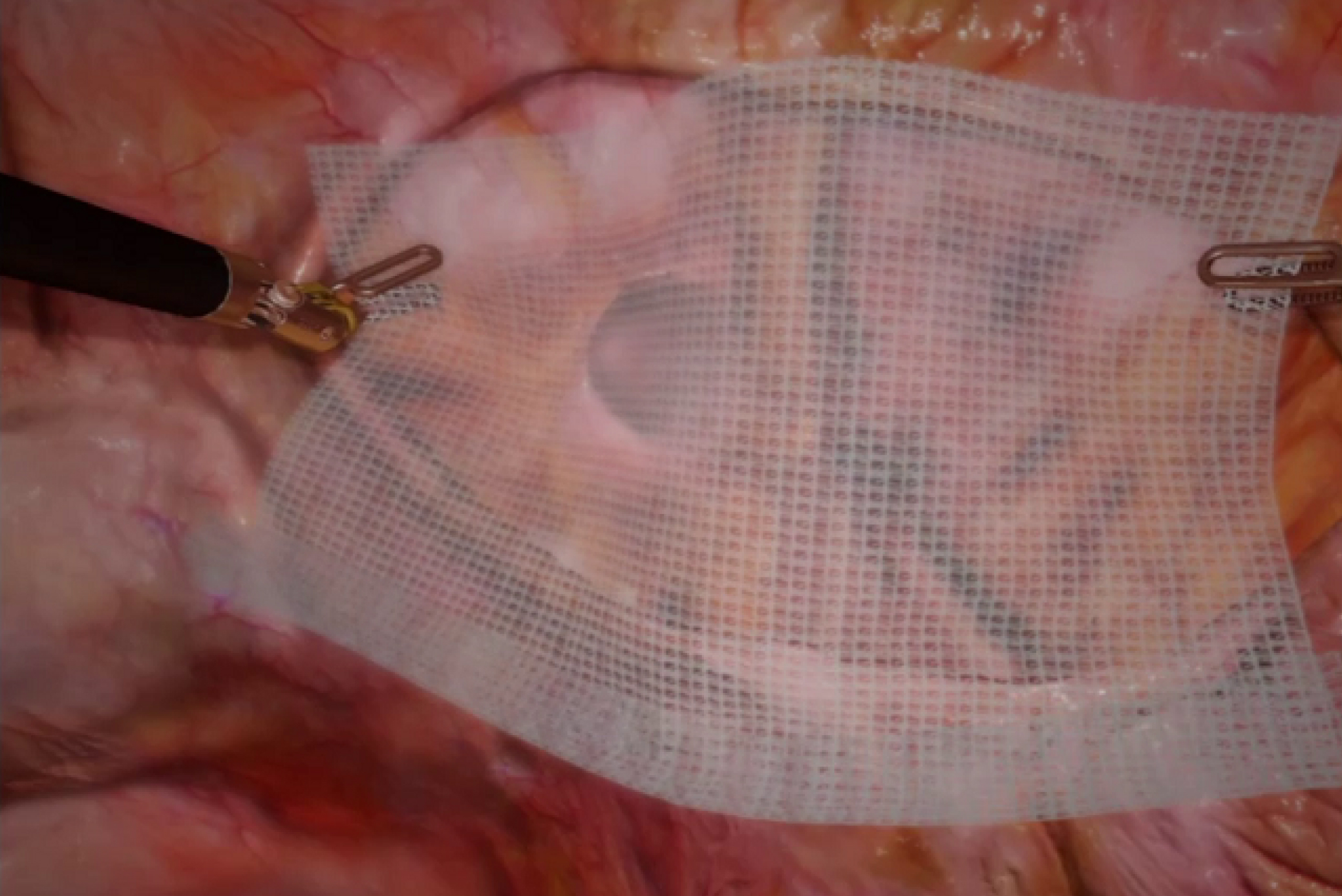 SimNow training module showing a hernia mesh